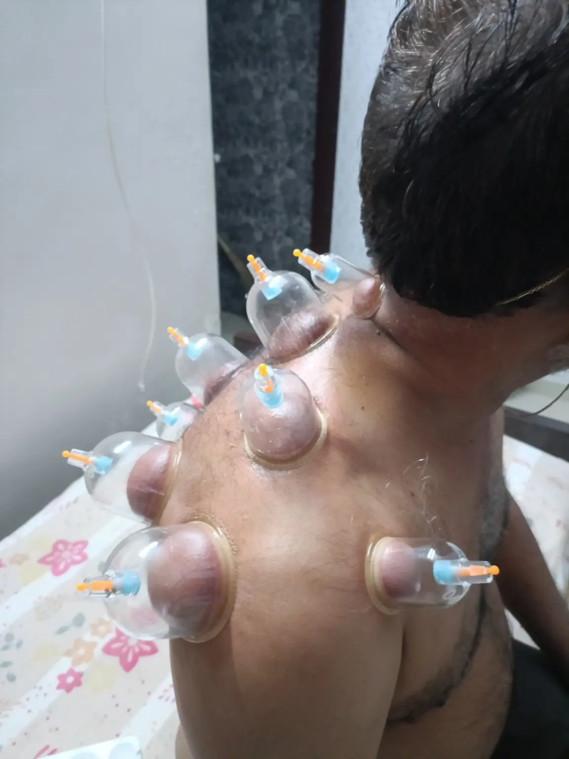 Cupping therapy applied to a patient’s back with no face or eyes visible