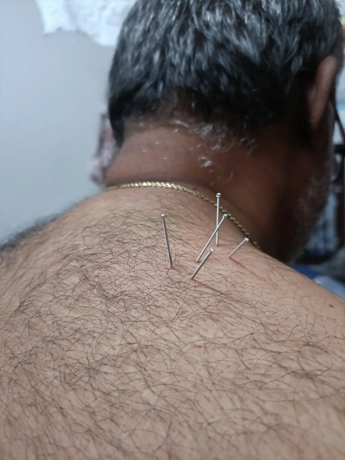 Dry needling treatment on a patient’s upper back with no face or eyes visible